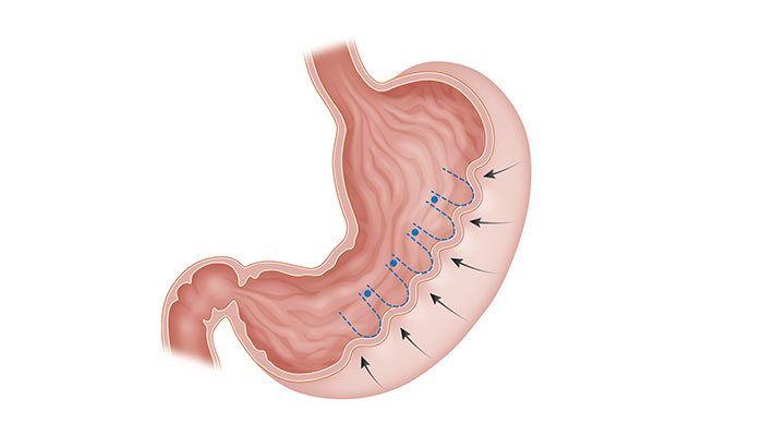 Illustration of endoscopic sleeve gastoplasty