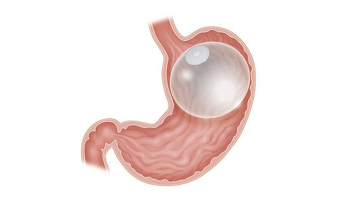lid cache kever Intragastric Balloon Weight Loss Procedure - Brigham and Women's Faulkner  Hospital