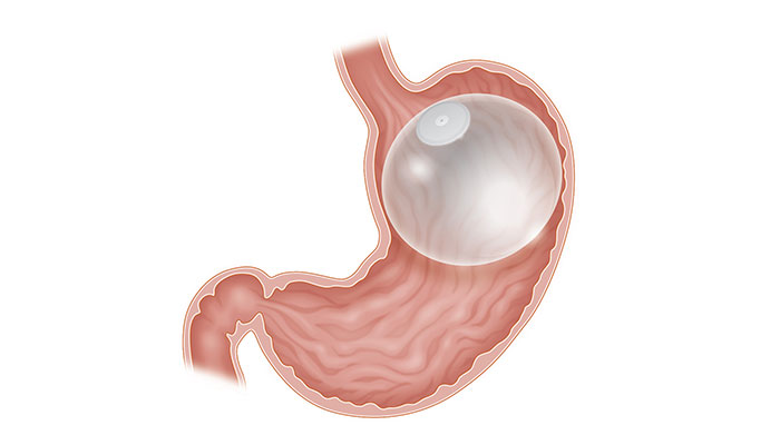 Illustration of orbera balloon
