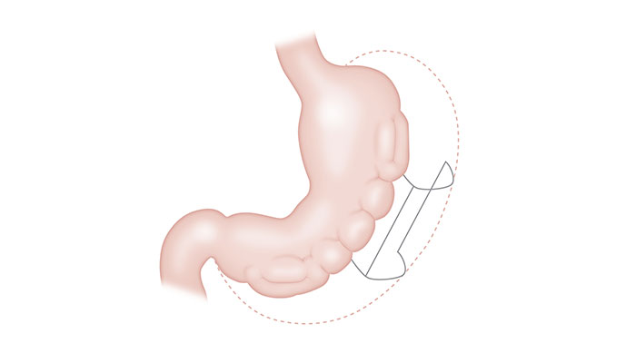 Aspiration Therapy - Brigham and Women's Faulkner Hospital