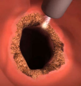 Image of Argon Plasma Coagulation