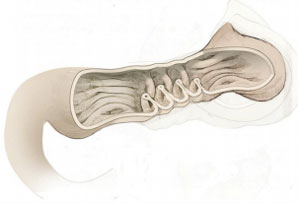 Image of Endoscopic Revision of Sleeve Gastrectomy