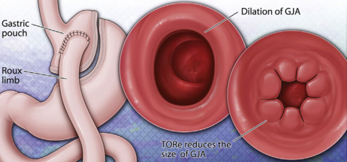 Image of TORe (Transoral Outlet Reduction) diagram