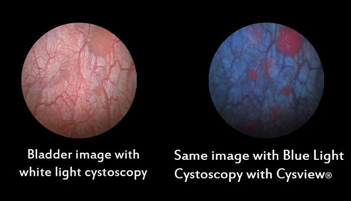 New procedure for bladder cancer