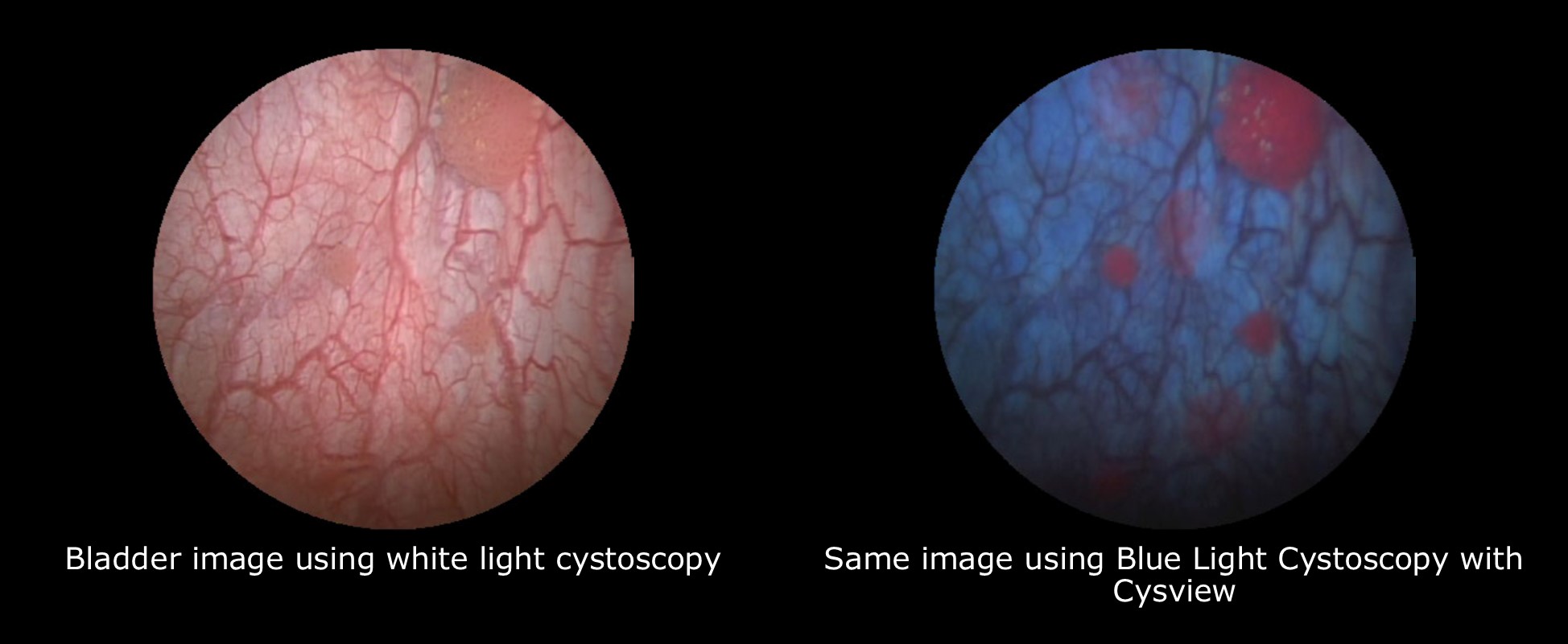 Blue Light Cystoscopy with Cysview