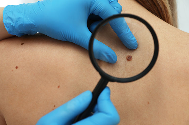 A gloved hand holding a magnifying glass over a mole on skin