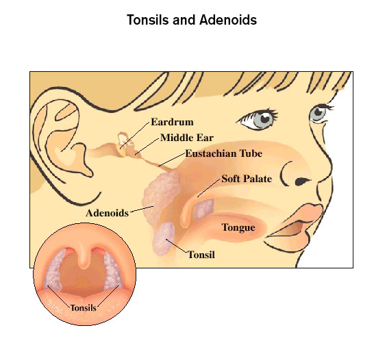 Image result for Adenoids and tonsils