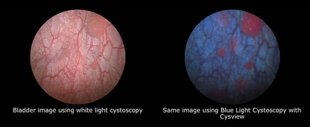 Blue Light Cystoscopy with Cysview 